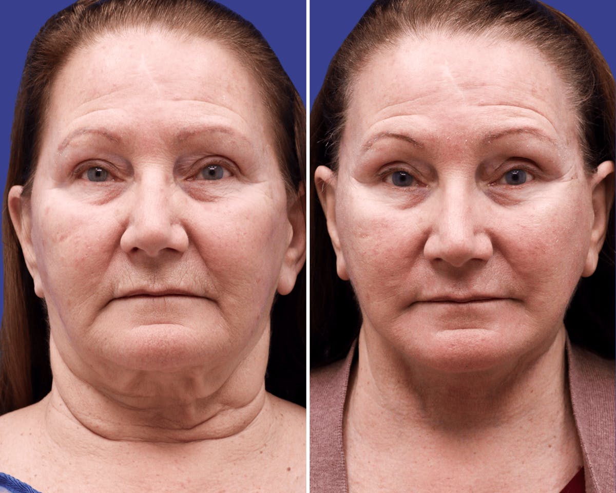 Neck Before & After Gallery - Patient 105588 - Image 2