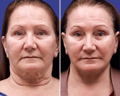 CO2 Laser Resurfacing Before & After Gallery - Patient 319632 - Image 1