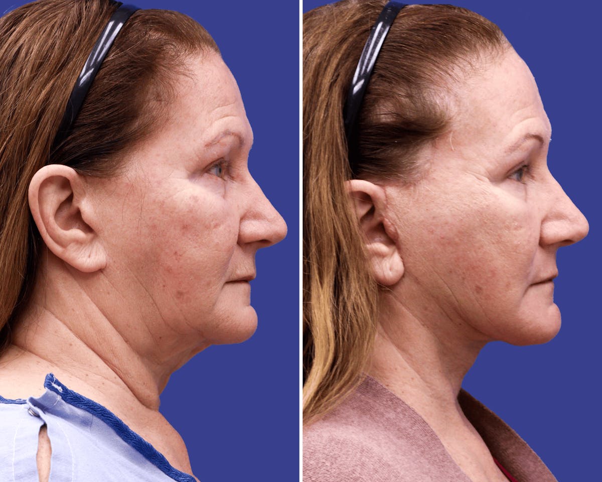 Neck Before & After Gallery - Patient 105588 - Image 1