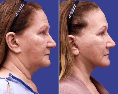 Neck Before & After Gallery - Patient 105588 - Image 1