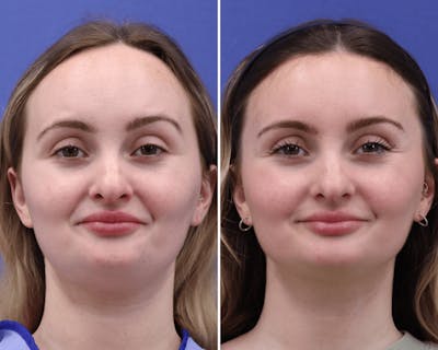 Face Before & After Gallery - Patient 351896 - Image 1