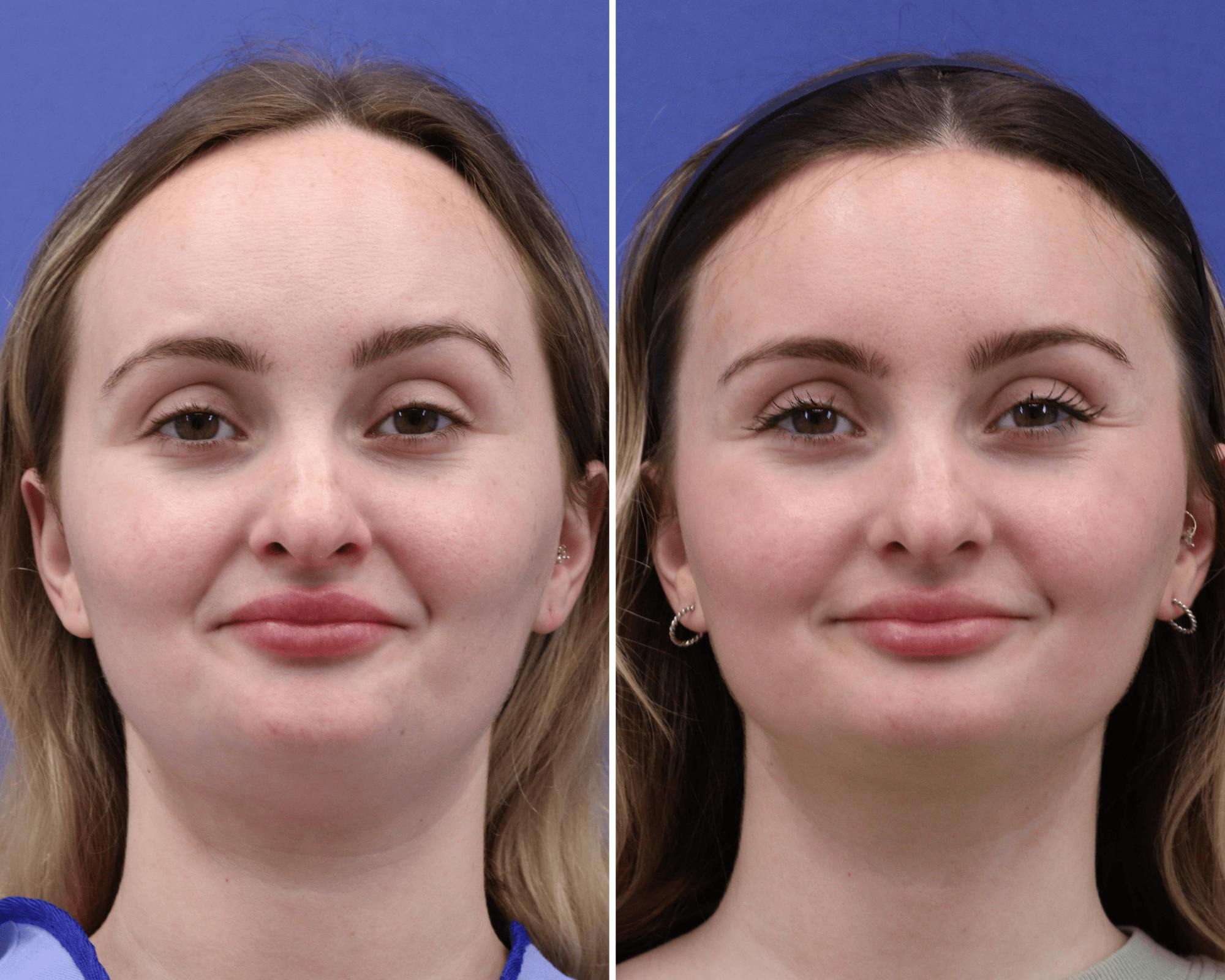 Face Before & After Gallery - Patient 351896 - Image 1
