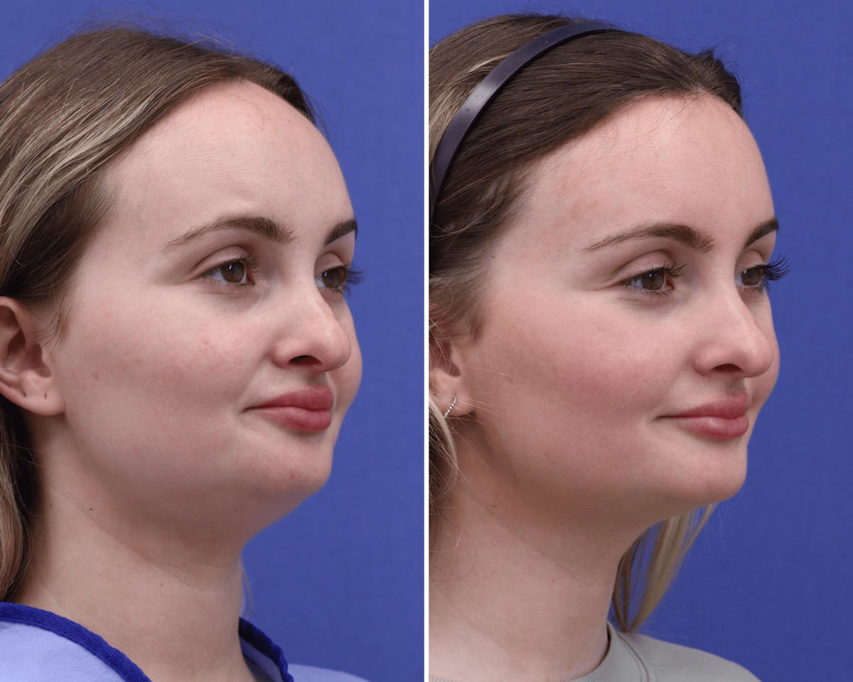 Face Before & After Gallery - Patient 351896 - Image 2