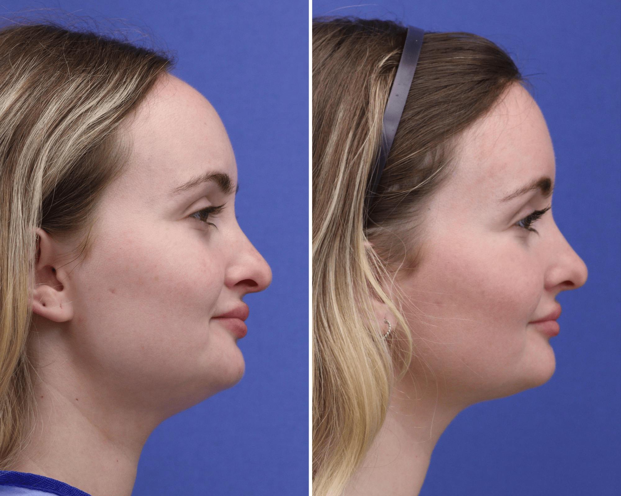 Face Before & After Gallery - Patient 351896 - Image 3