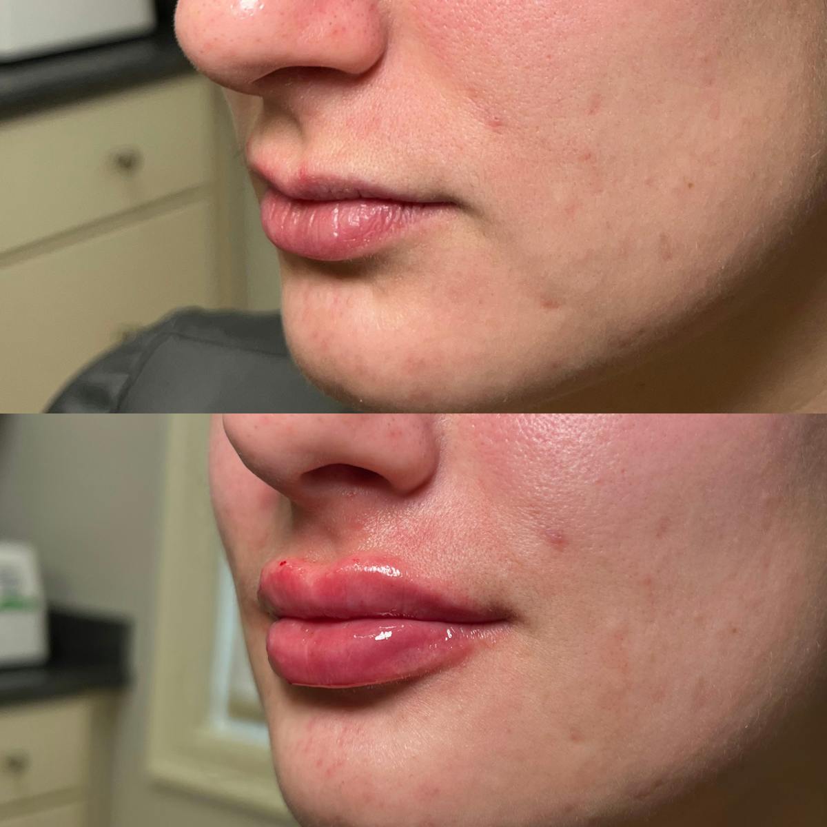 Lips Before & After Gallery - Patient 408249 - Image 1