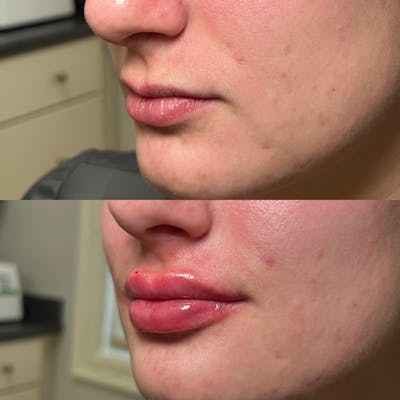 Lips Before & After Gallery - Patient 408249 - Image 1