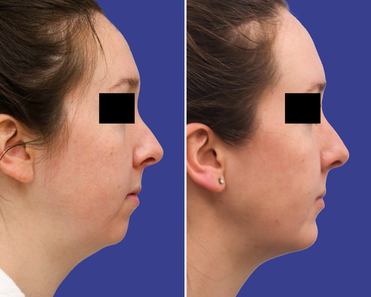 Neck Before & After Gallery - Patient 131237 - Image 3