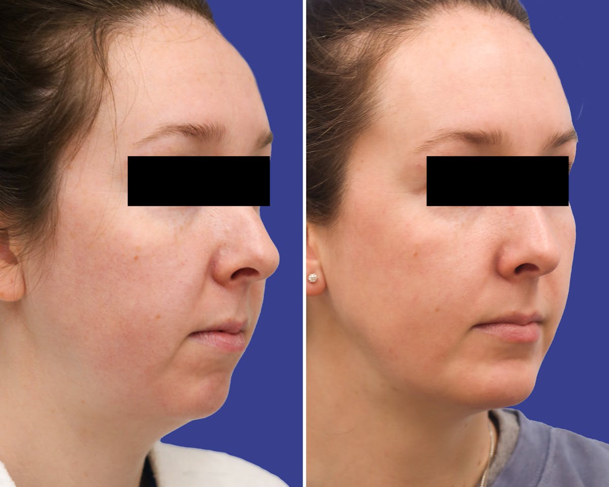 Neck Before & After Gallery - Patient 131237 - Image 2