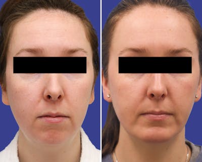 Neck Before & After Gallery - Patient 131237 - Image 1