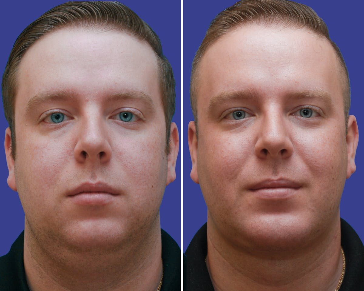 Neck Before & After Gallery - Patient 188390 - Image 1