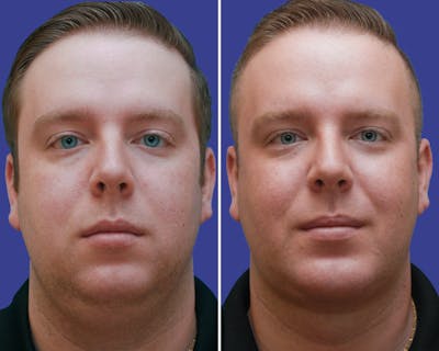 Neck Before & After Gallery - Patient 188390 - Image 1