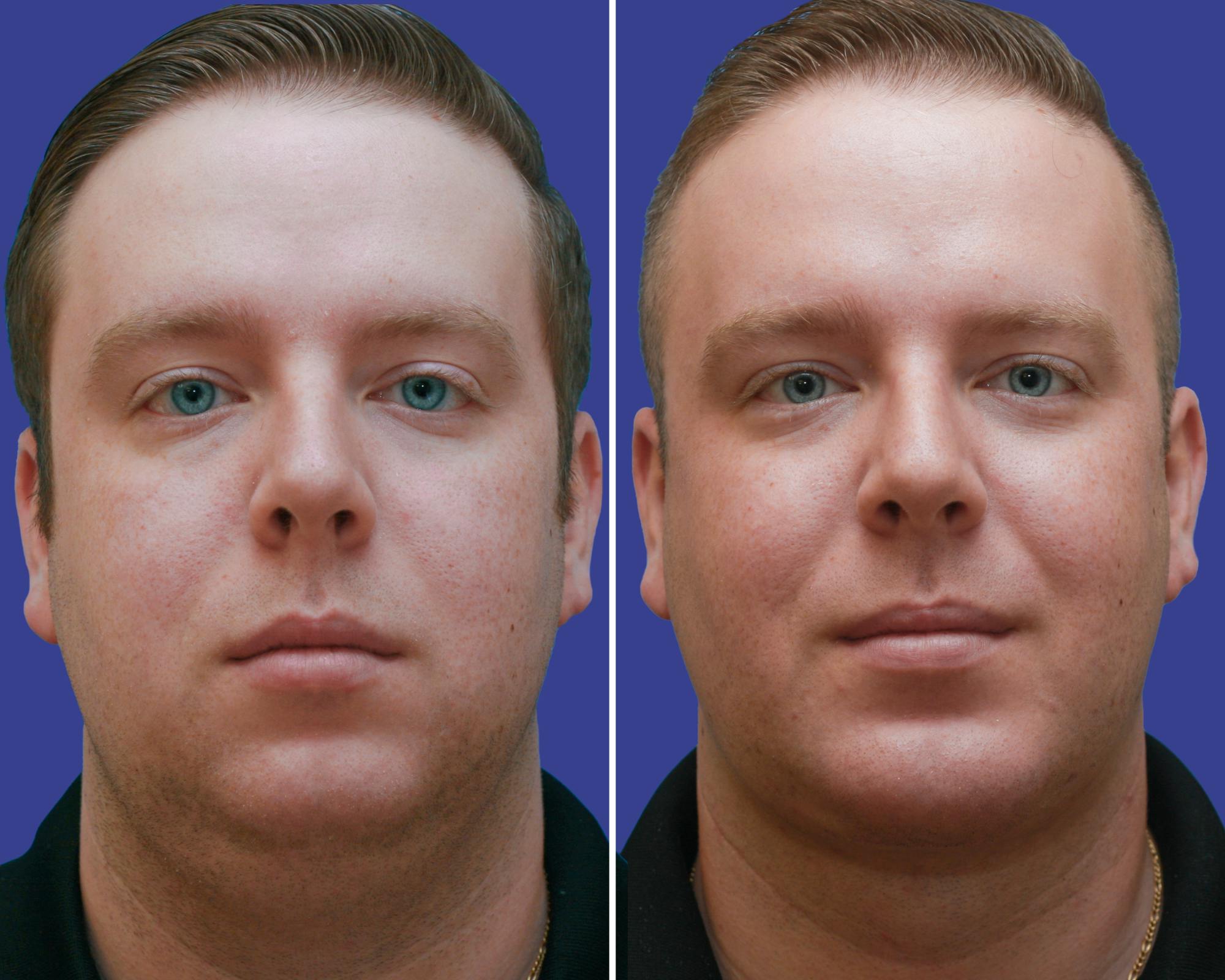 Chin Implants Before & After Gallery - Patient 203308 - Image 1