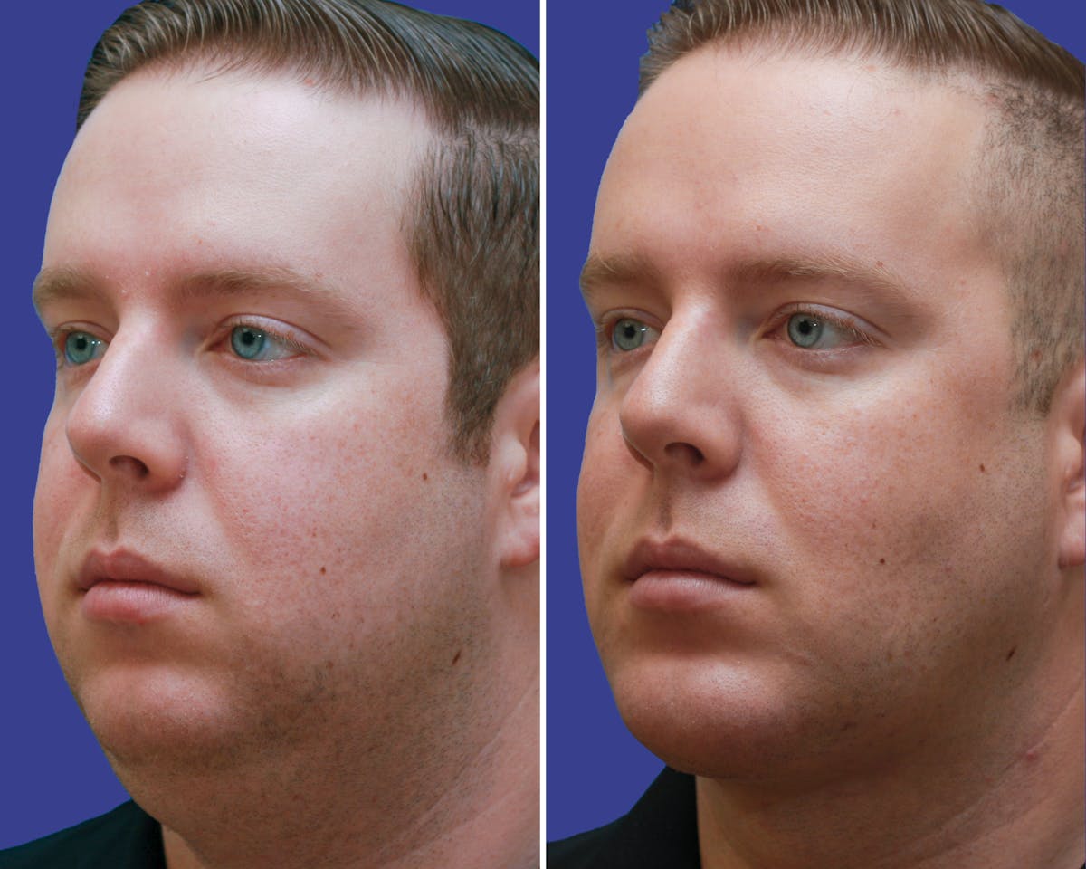 Neck Before & After Gallery - Patient 188390 - Image 2