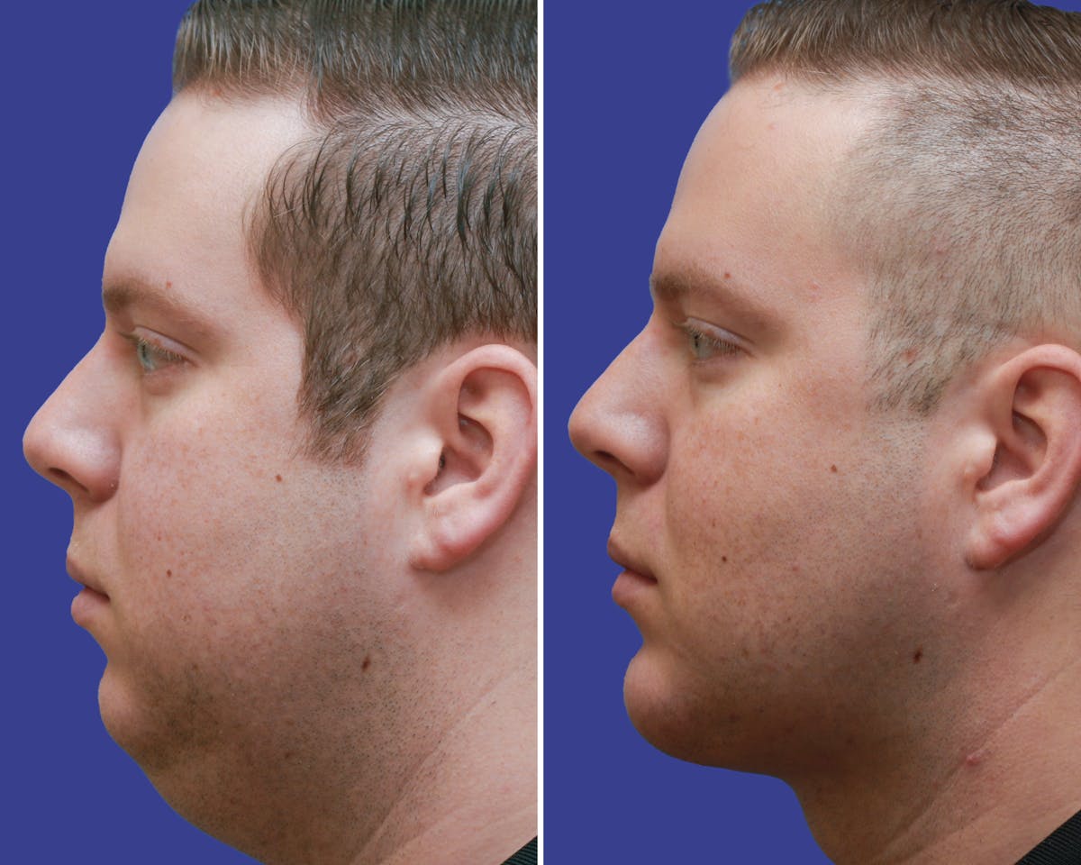 Neck Before & After Gallery - Patient 188390 - Image 3