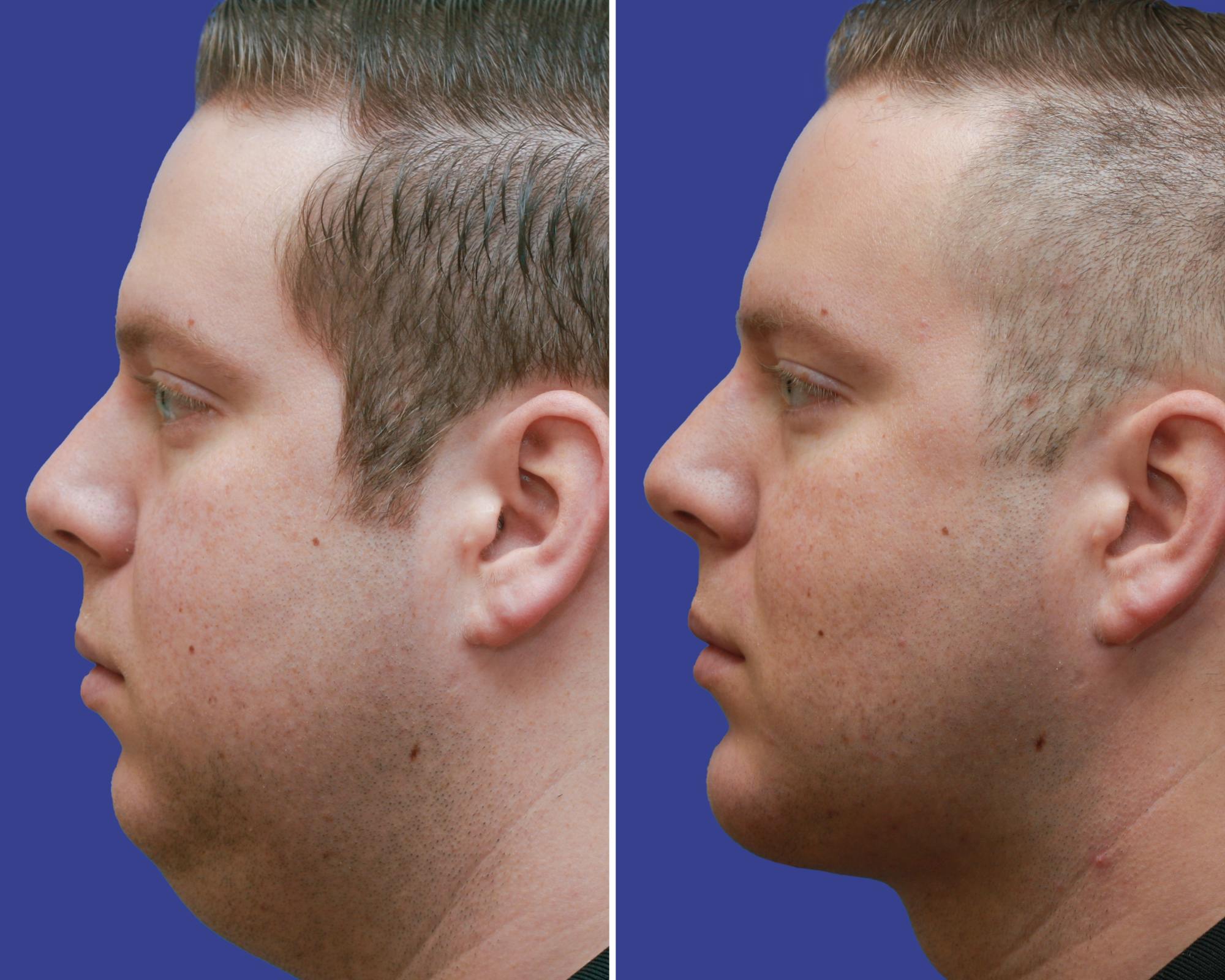 Chin Implants Before & After Gallery - Patient 203308 - Image 3