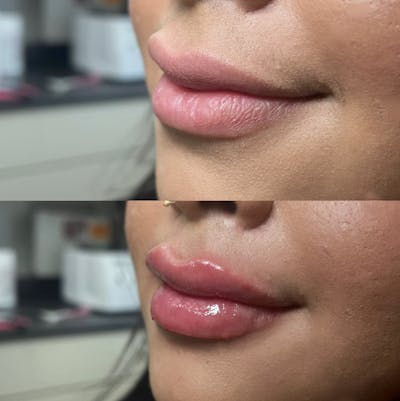 Lips Before & After Gallery - Patient 370463 - Image 1