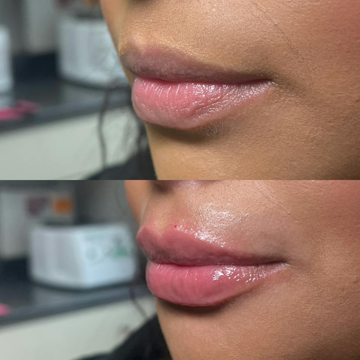 Lips Before & After Gallery - Patient 103741 - Image 1