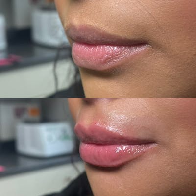 Lips Before & After Gallery - Patient 103741 - Image 1
