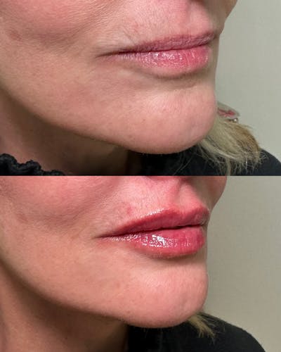 Lips Before & After Gallery - Patient 417715 - Image 1