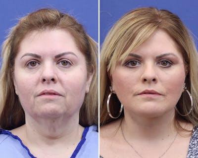 Face Before & After Gallery - Patient 214581 - Image 1