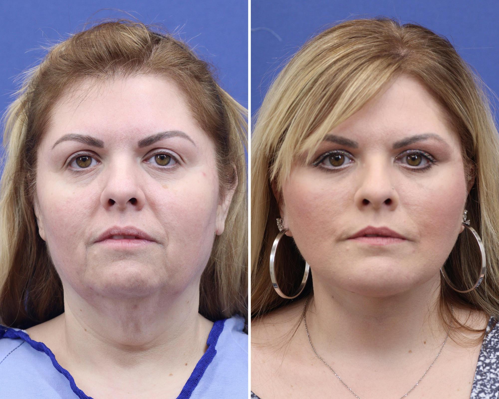 Chin Implants Before & After Gallery - Patient 165352 - Image 2