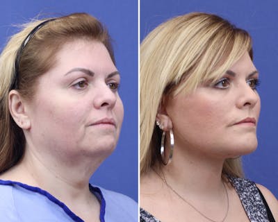 Chin Implants Before & After Gallery - Patient 165352 - Image 1