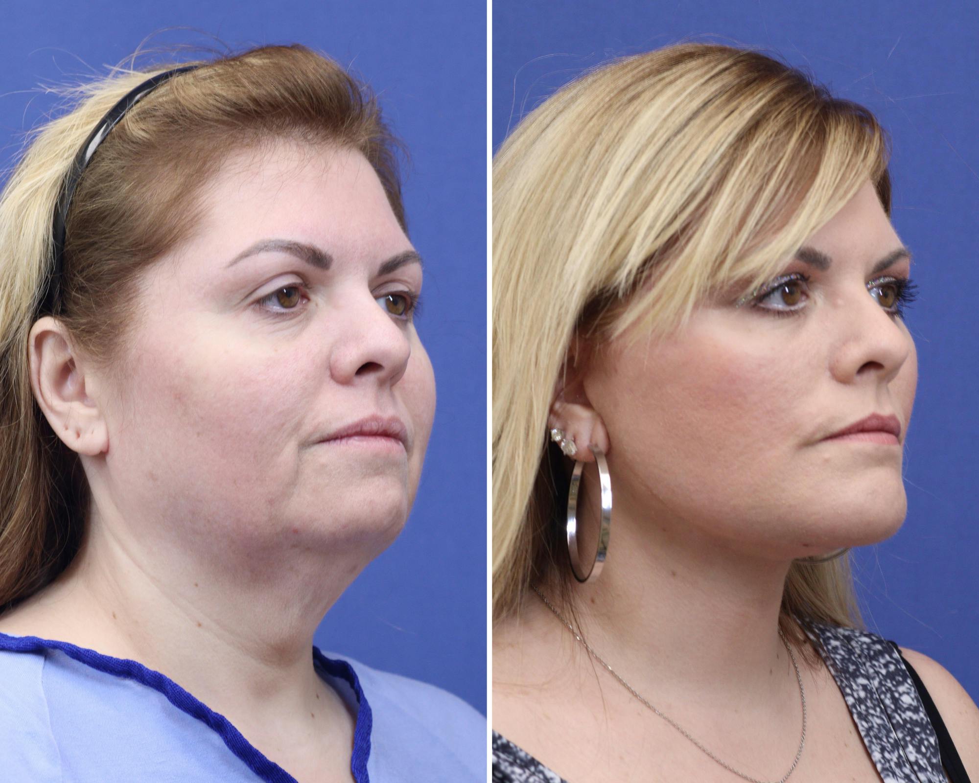 Chin Implants Before & After Gallery - Patient 165352 - Image 1