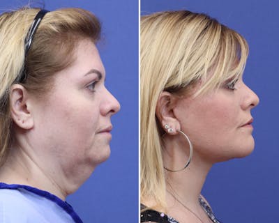 Neck Before & After Gallery - Patient 370455 - Image 1