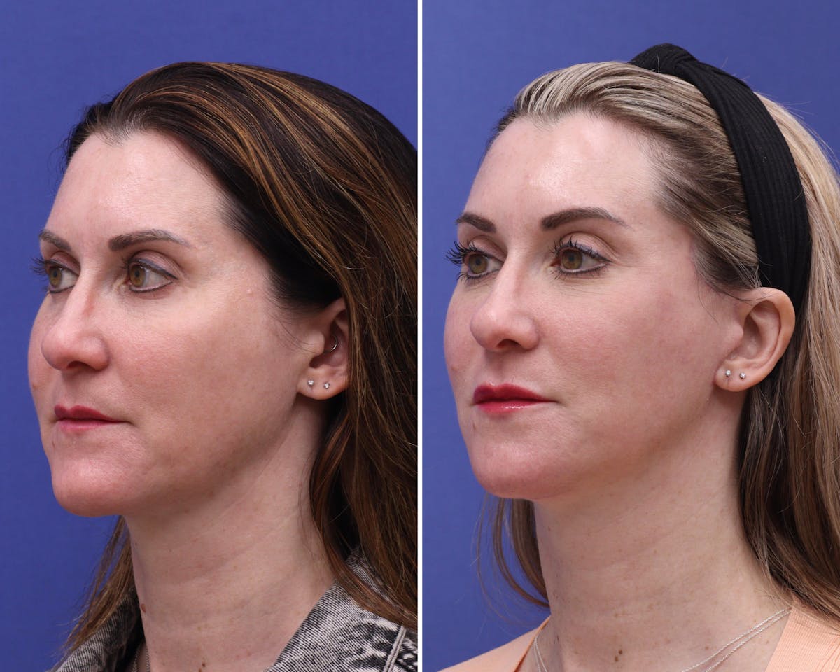 Facelift Before & After Gallery - Patient 200063 - Image 1