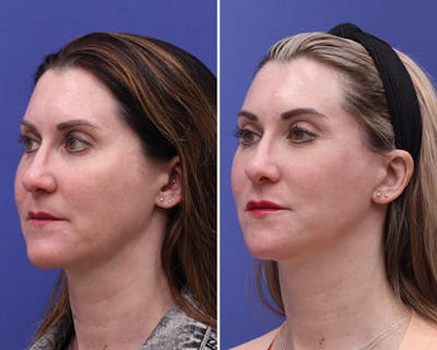 Face Before & After Gallery - Patient 391972 - Image 1