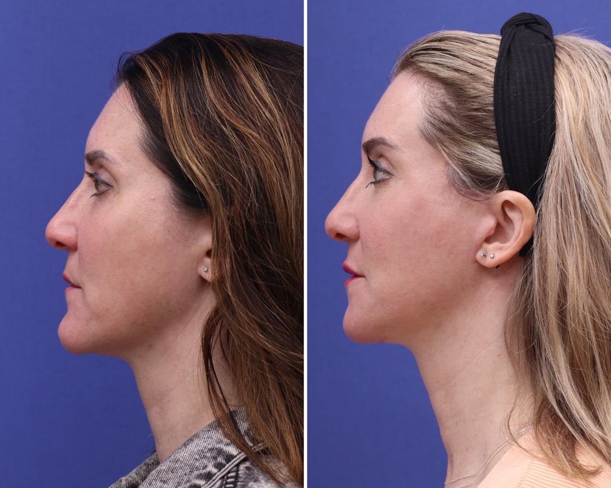Facelift Before & After Gallery - Patient 200063 - Image 2