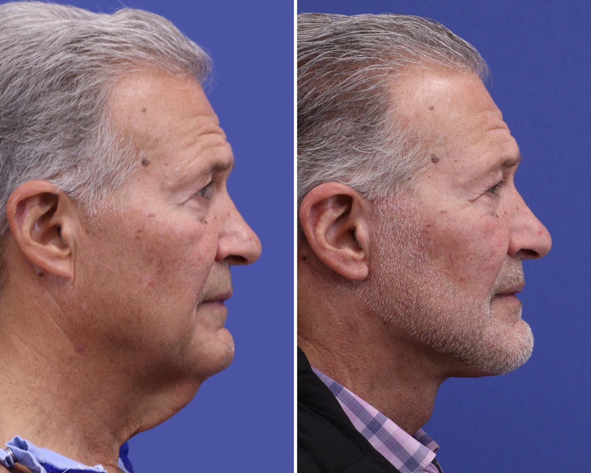 Neck Before & After Gallery - Patient 249052 - Image 1