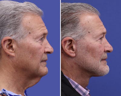 Neck Before & After Gallery - Patient 249052 - Image 1