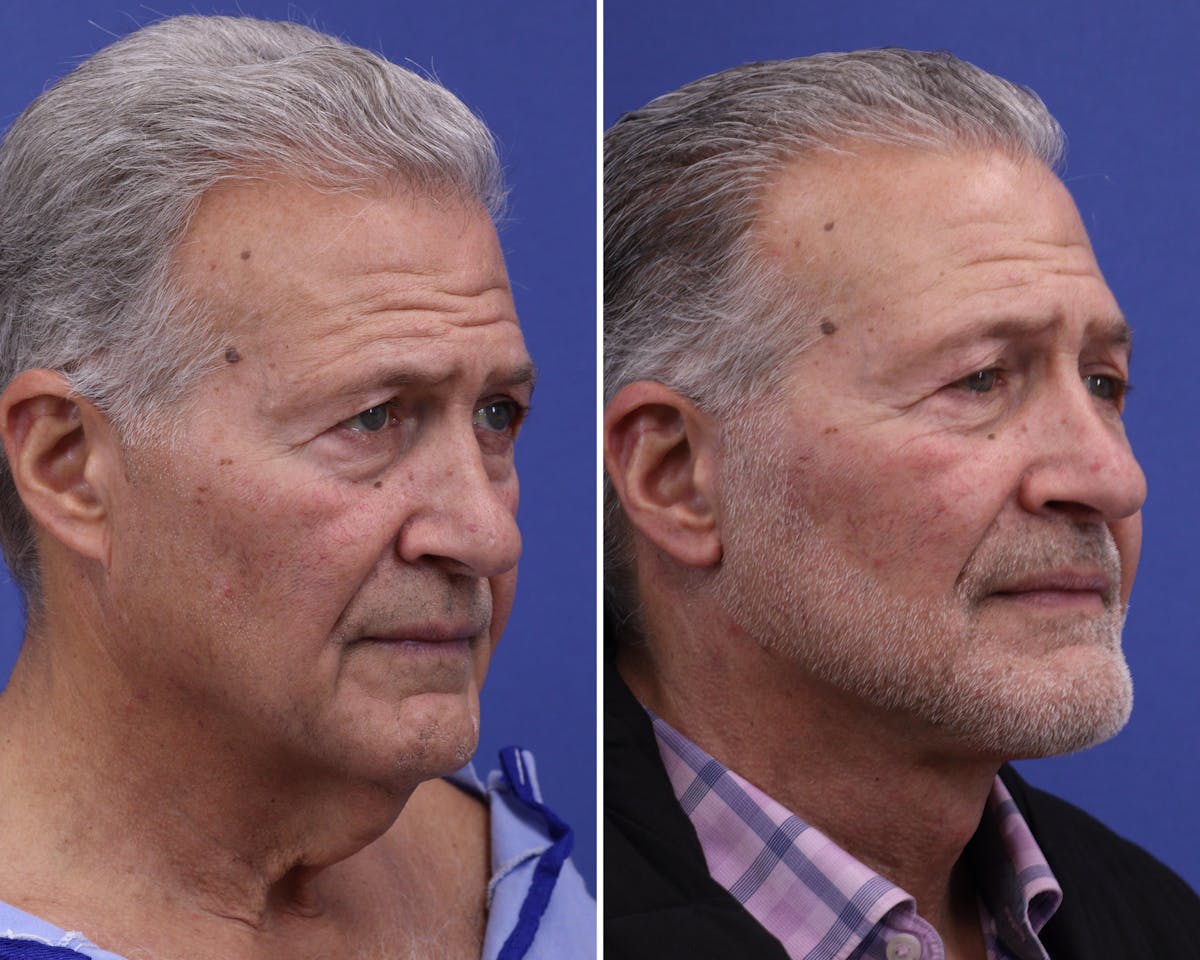 Neck Before & After Gallery - Patient 249052 - Image 2