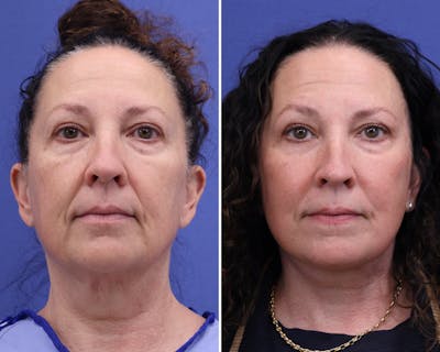 Face Before & After Gallery - Patient 409640 - Image 1