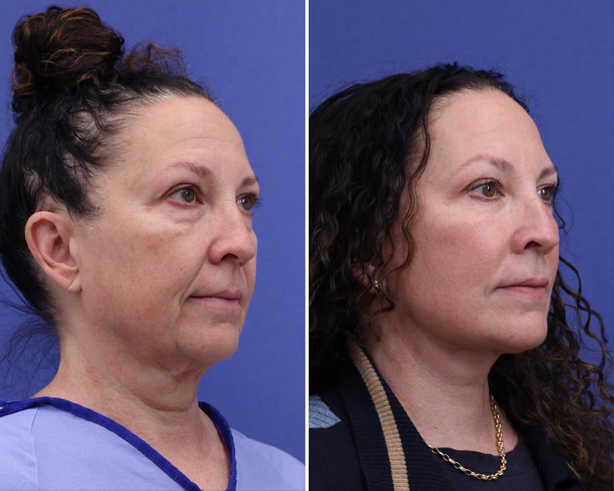 Neck Before & After Gallery - Patient 627418 - Image 2