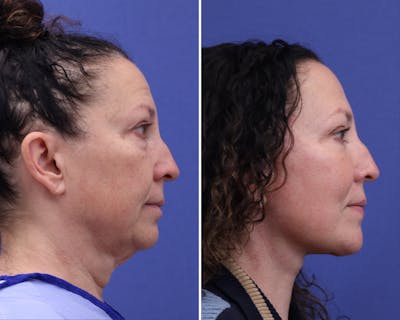 Neck Before & After Gallery - Patient 627418 - Image 1