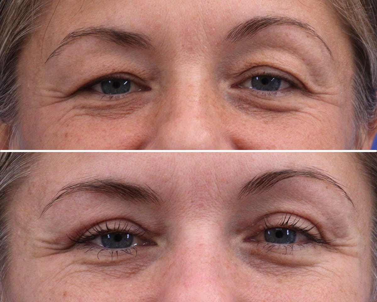 Blepharoplasty Before & After Gallery - Patient 374279 - Image 1