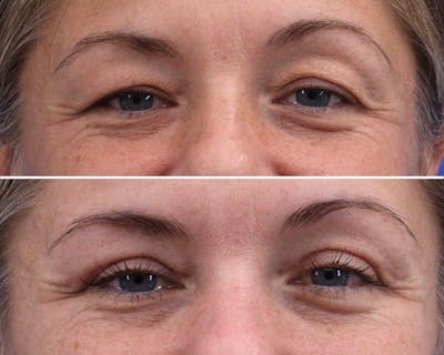Blepharoplasty Before & After Gallery - Patient 374279 - Image 1
