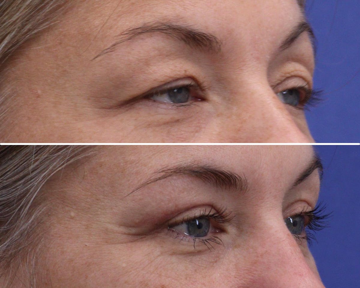 Blepharoplasty Before & After Gallery - Patient 374279 - Image 2