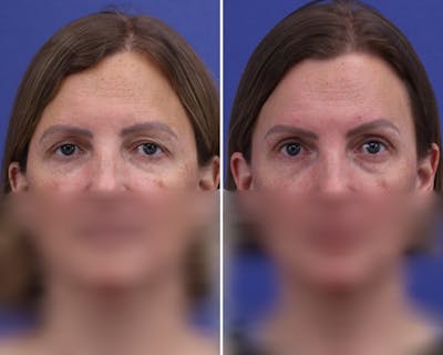 Temple Lift Before & After Gallery - Patient 746191 - Image 1
