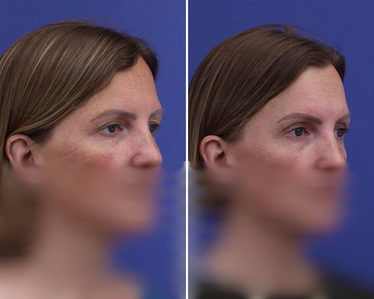 Temple Lift Before & After Gallery - Patient 746191 - Image 2