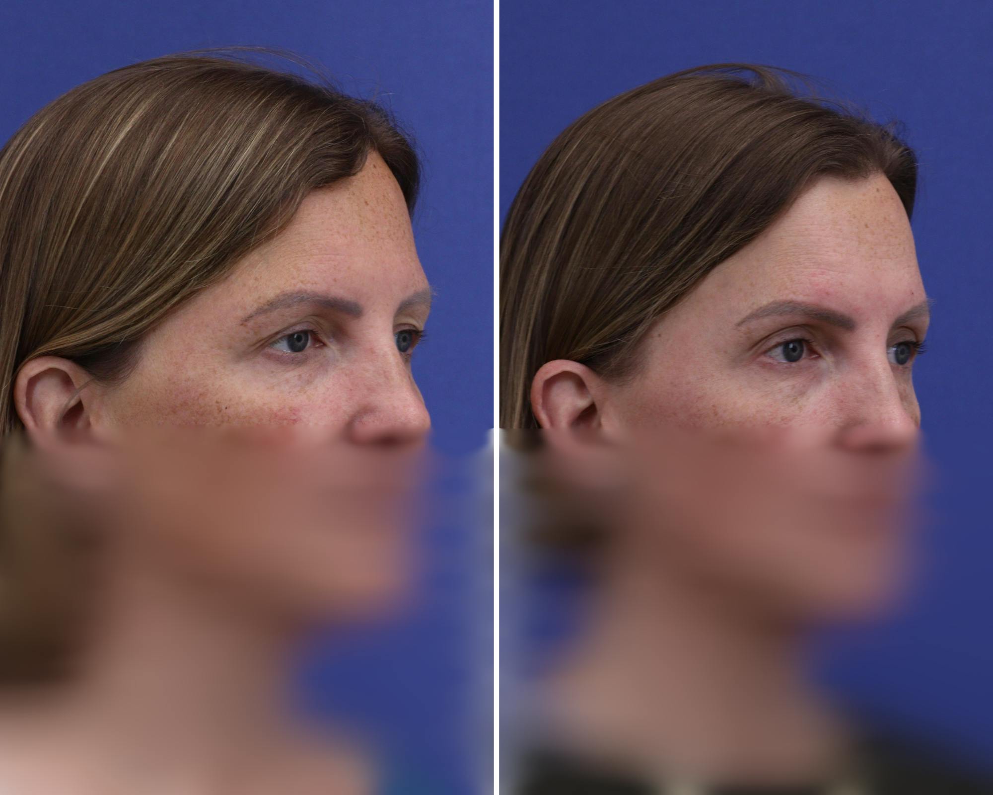 Temple Lift Before & After Gallery - Patient 746191 - Image 2