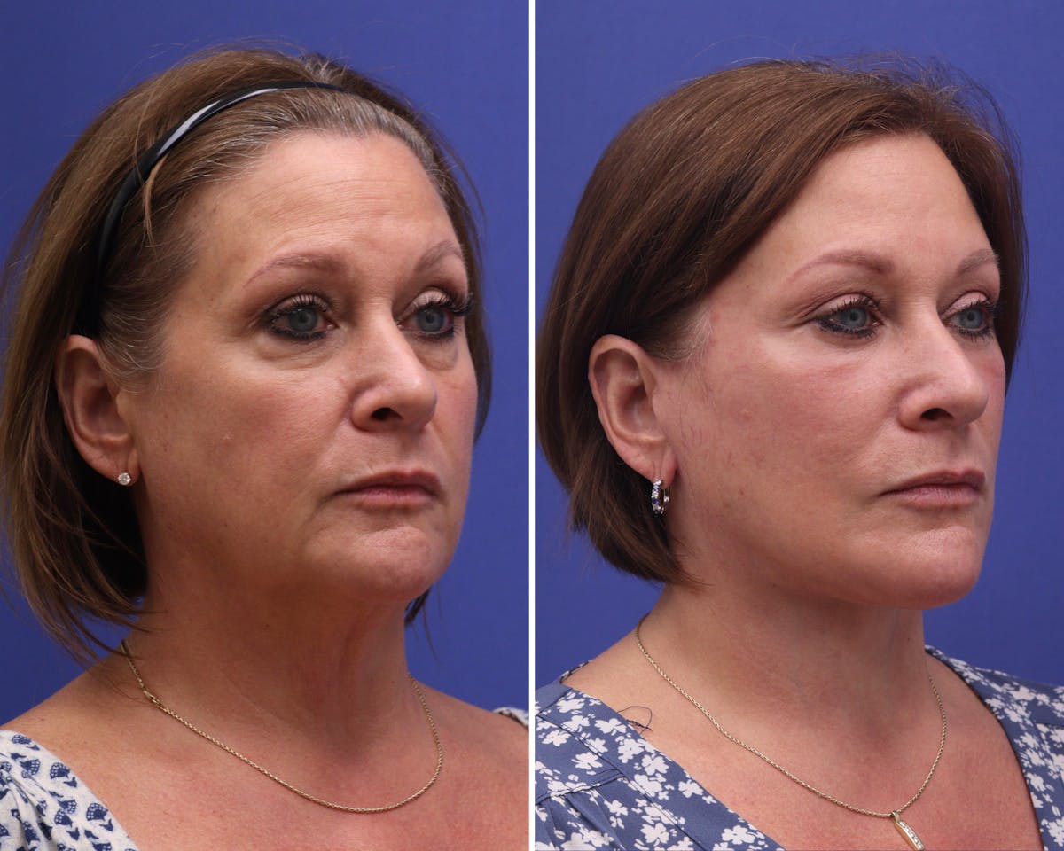 Neck Before & After Gallery - Patient 385164 - Image 1
