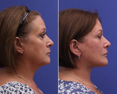 Neck Lift Before & After Gallery - Patient 299052 - Image 1