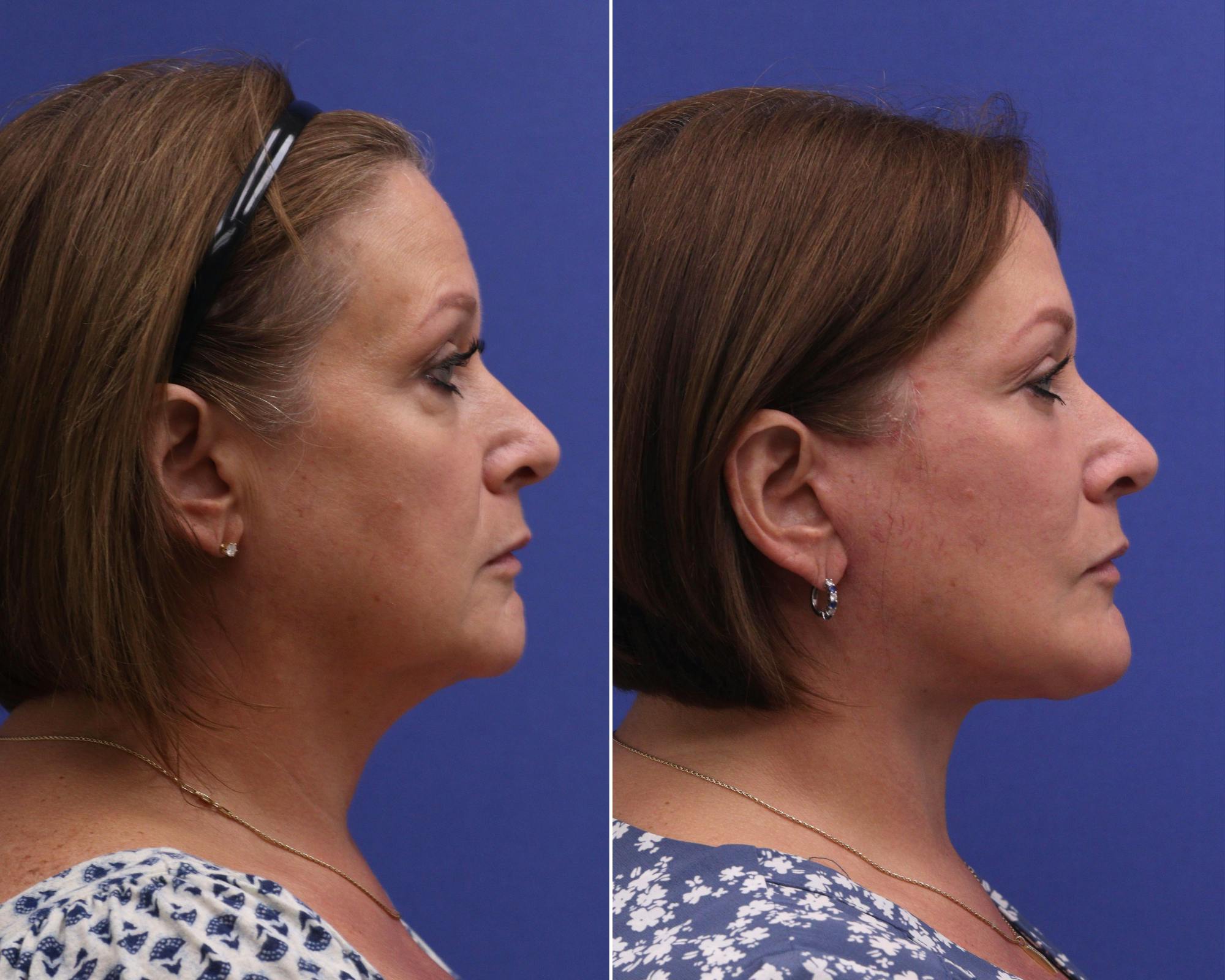 Temple Lift Before & After Gallery - Patient 232202 - Image 2