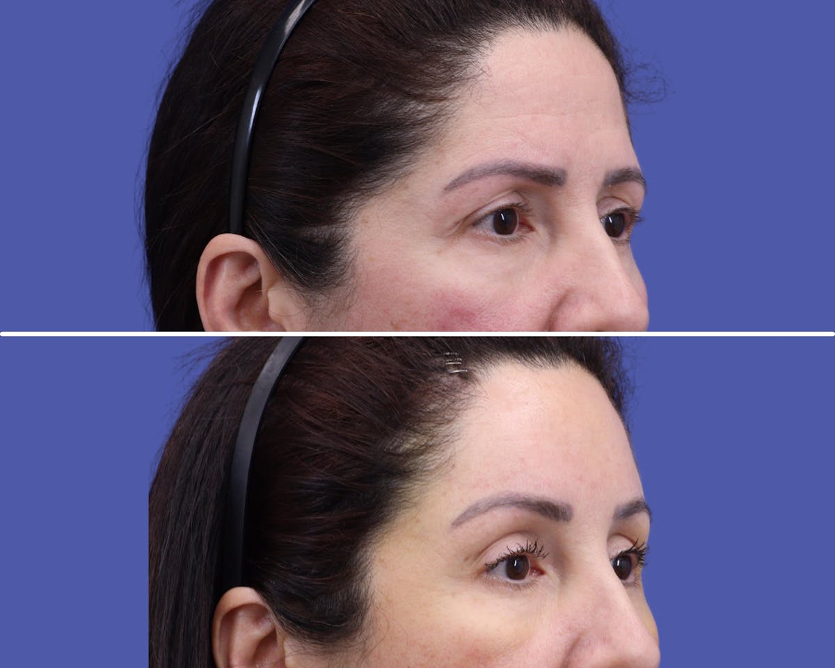 Temple Lift Before & After Gallery - Patient 661787 - Image 2