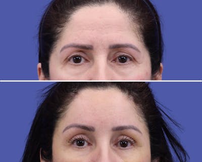 Temple Lift Before & After Gallery - Patient 661787 - Image 1