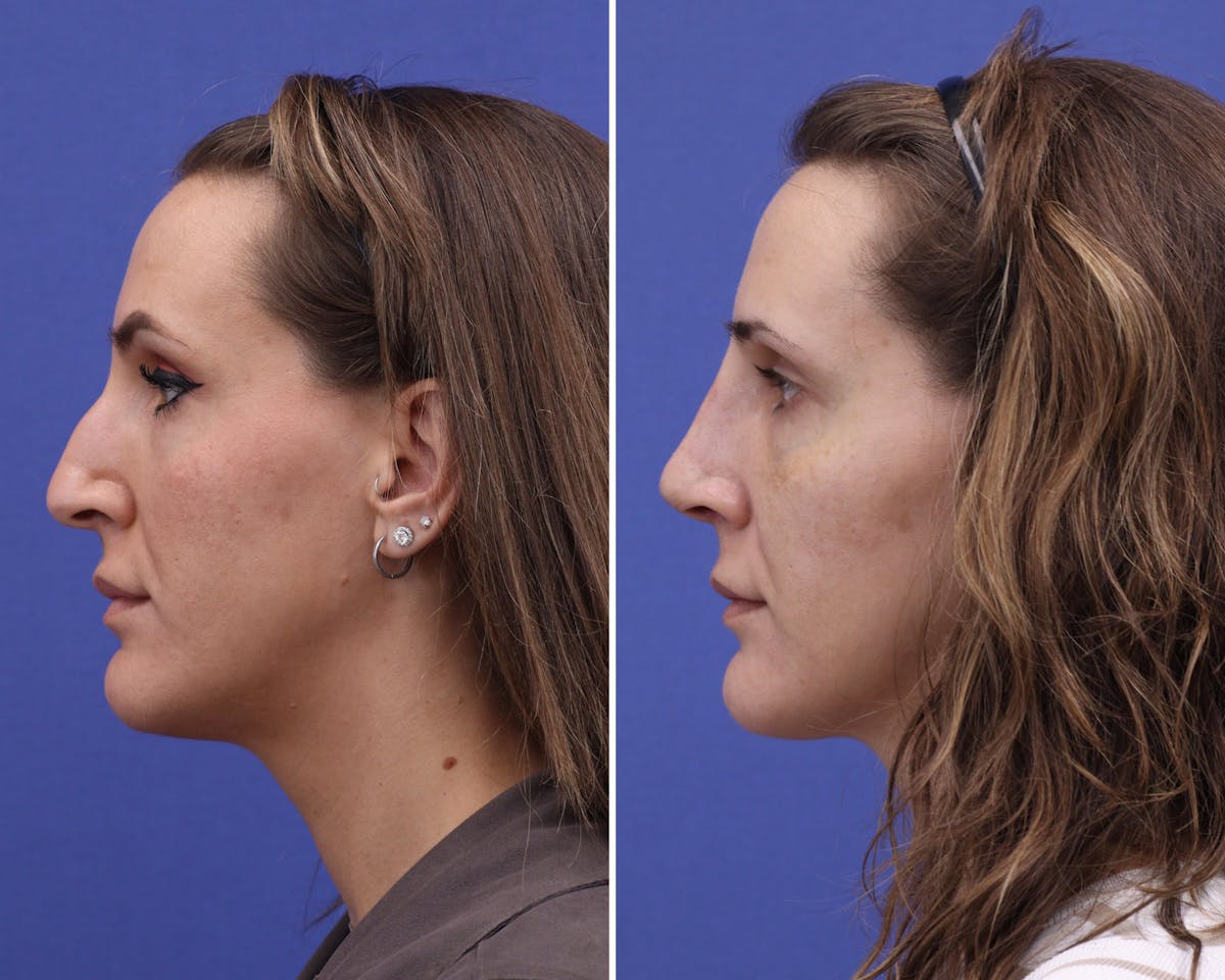 Rhinoplasty Before & After Gallery - Patient 175236 - Image 2