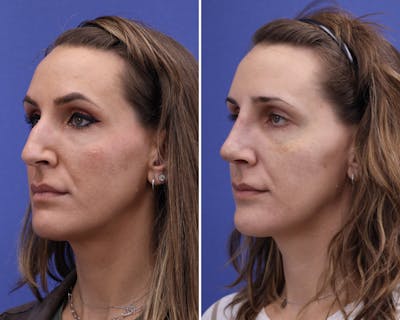 Rhinoplasty Before & After Gallery - Patient 175236 - Image 1